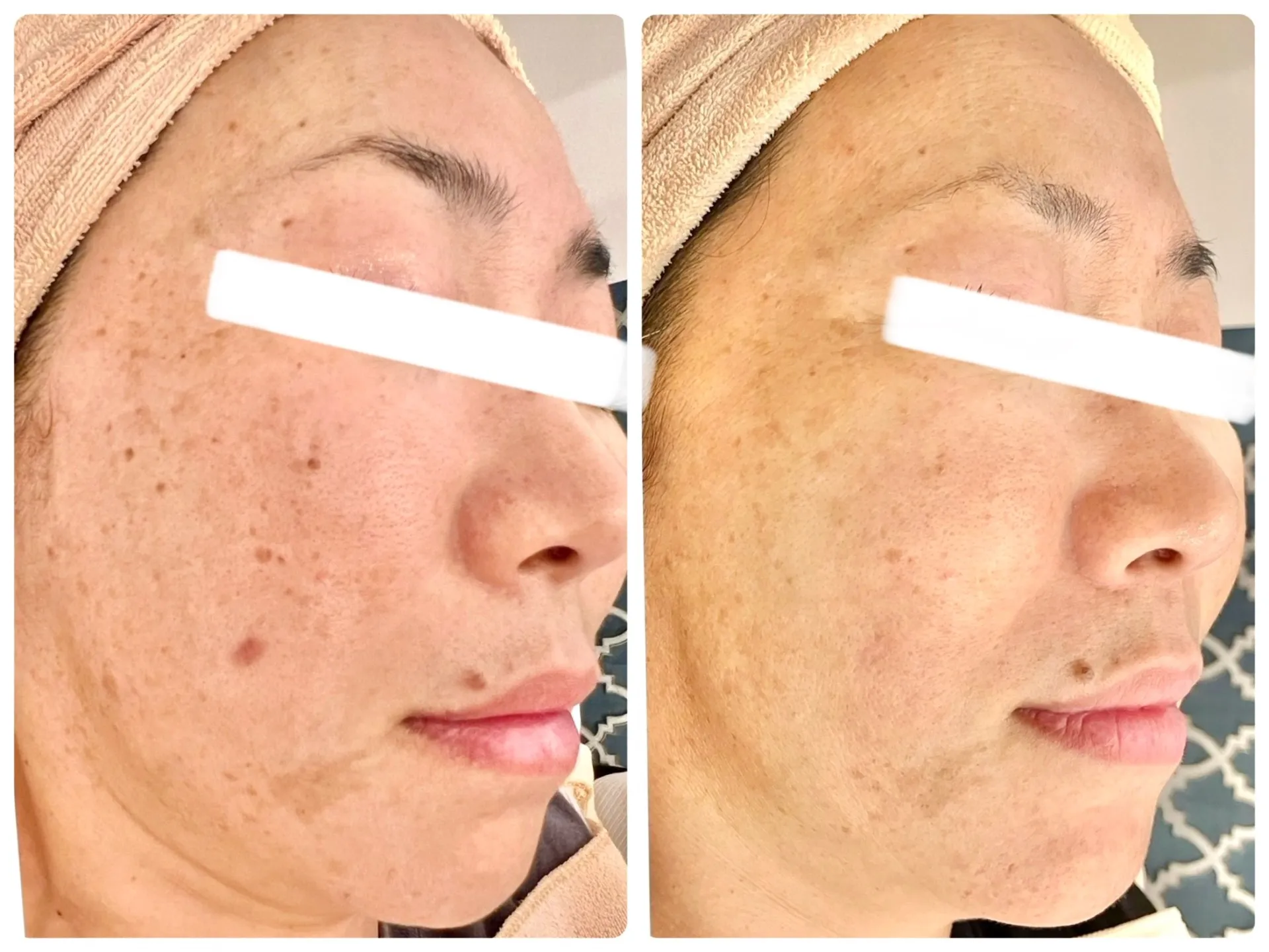 【肌荒れ跡】もう隠さなくていい!肌荒れの跡集中改善+凹凸肌リセット!