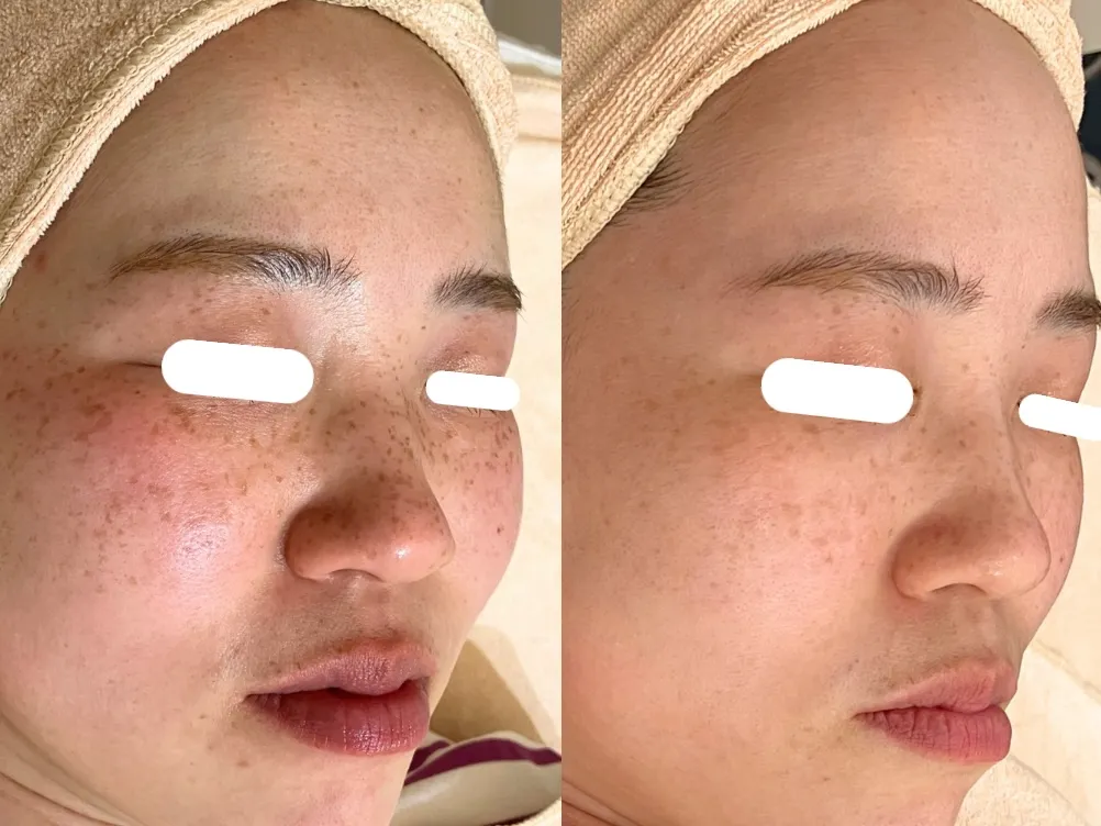 【そばかす】昔からのその悩み、もう無くしましょ?そばかす集中ケア¥11,000