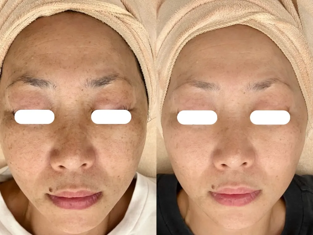 【美白】地黒で悩まれている方へ。私だって美白になりたい!美肌改善11,000円